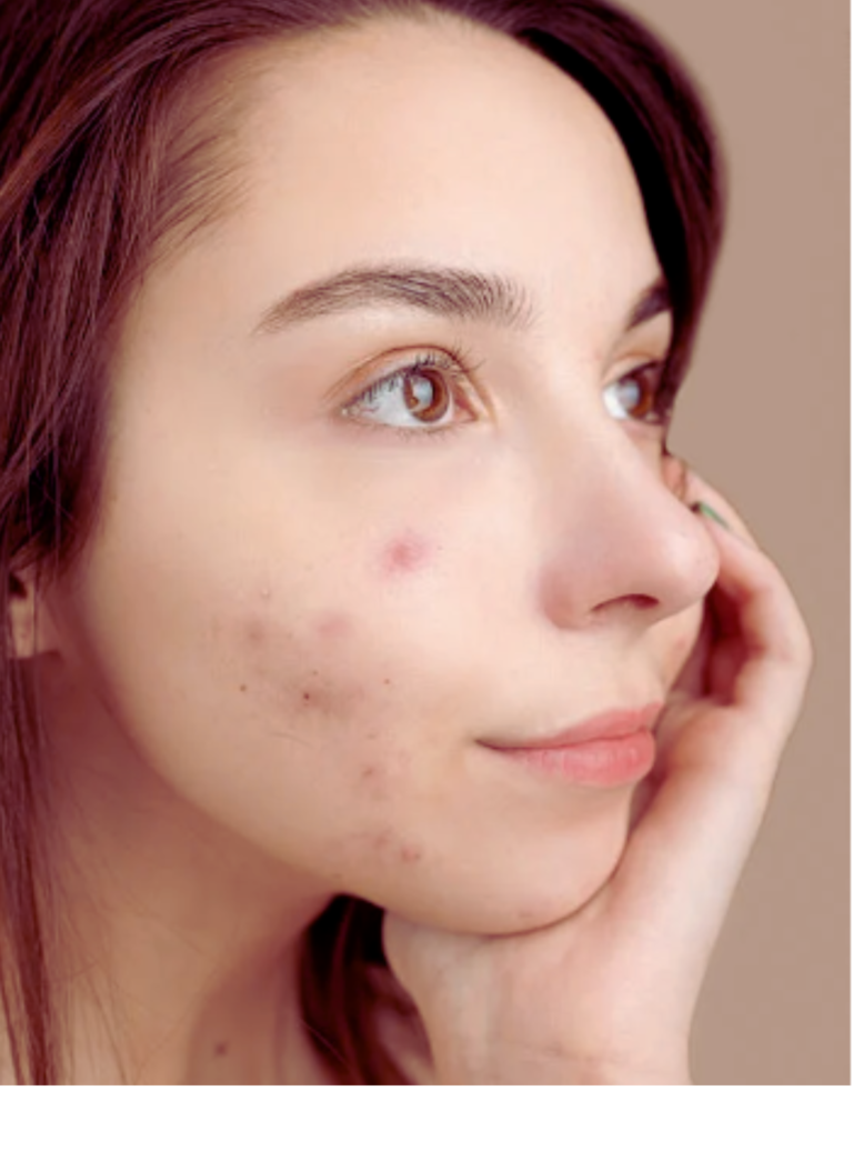 Fast Ways to Reduce Acne Dark Spots On The Face
